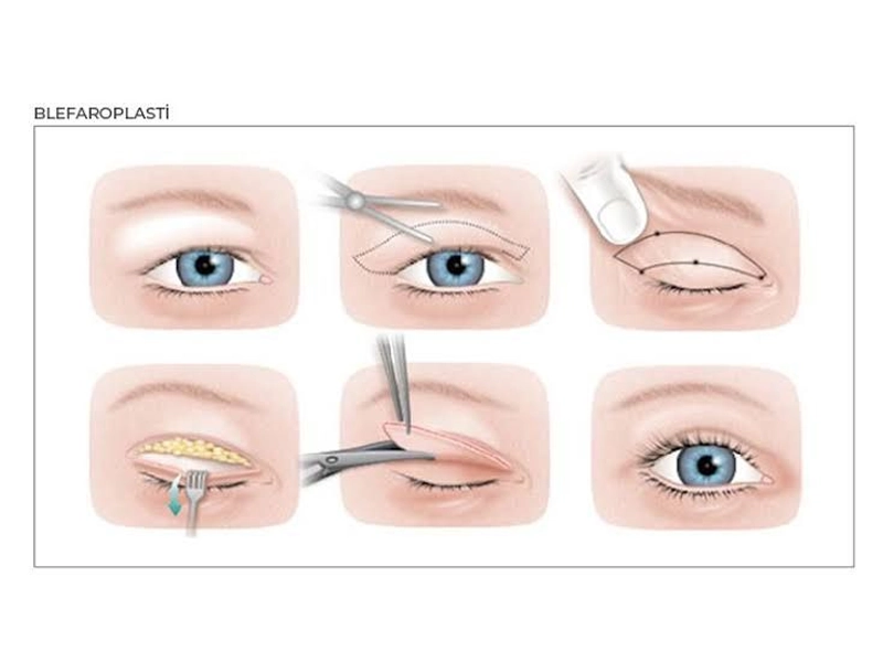 بلفاروپلاستی چگونه انجام می‌شود؟