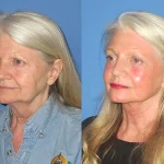 لیفت صورت با تکنیک منحصر به فرد و خاص