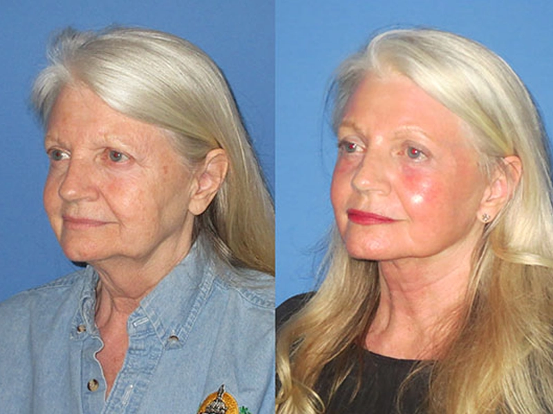 لیفت صورت با تکنیک منحصر به فرد و خاص