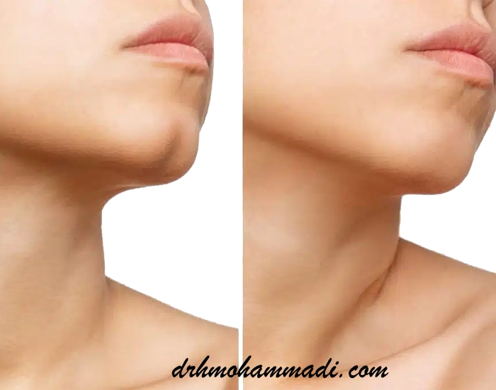 منتوپلاستی