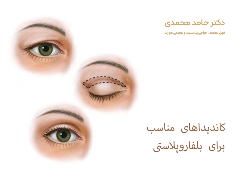 کاندیداهای مناسب برای بلفاروپلاستی