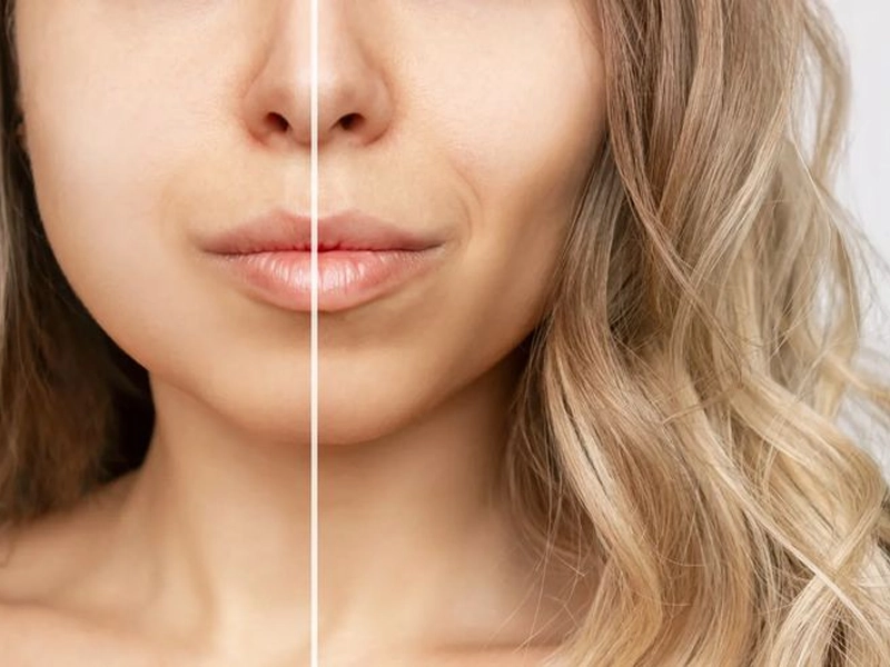 جراحی بوکال فت صورت