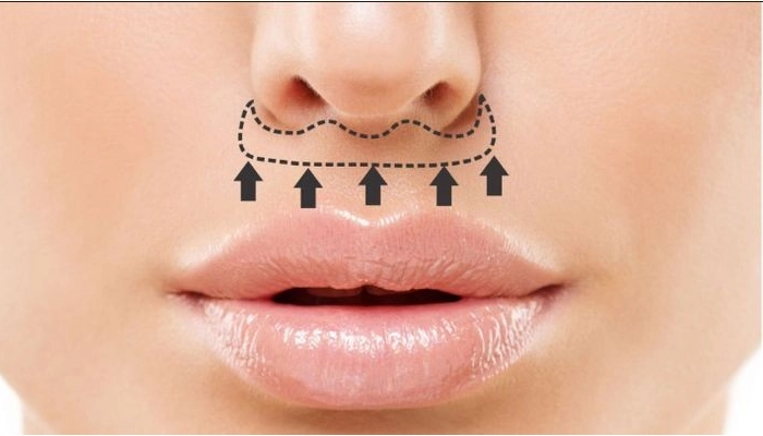 جراحی لیفت لب