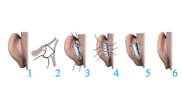 مراحل انجام جراحی زیبایی گوش