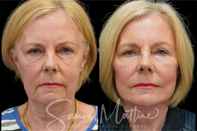 نمونه کار لیفت صورت و گردن