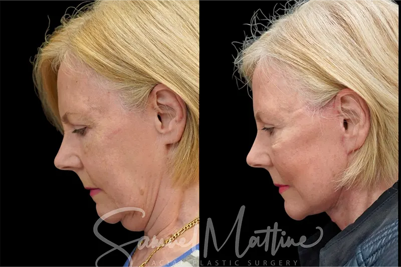 نمونه کار لیفت صورت و گردن