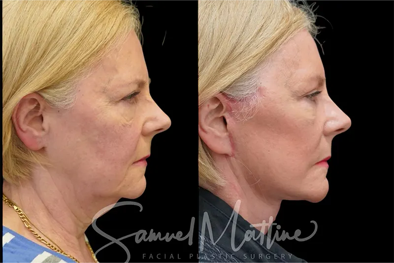 نمونه کار لیفت صورت و گردن