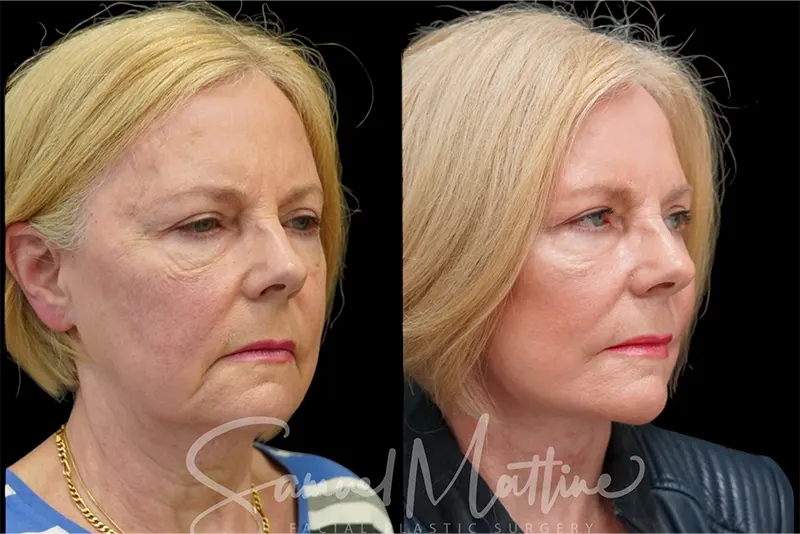 نمونه کار لیفت صورت و گردن