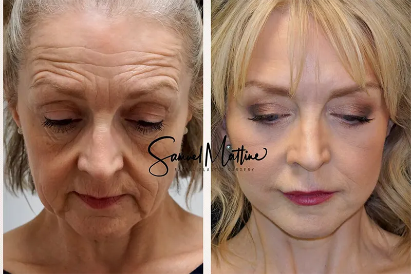 نمونه کار لیفت صورت و گردن