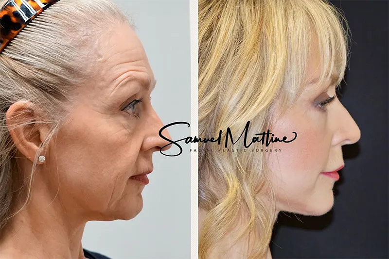 نمونه کار لیفت صورت و گردن