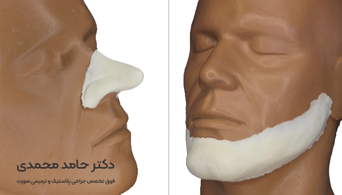 پروتز بینی فک