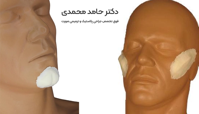 پروتز گونه و چانه